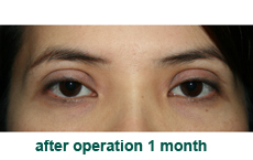 plastic-surgery-blepharoplasty